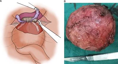 Leiomyoma of the prostate: A case report and systematic review